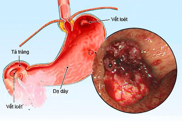 Chuyện tình dục ở người đau dạ dày - Ảnh 1.