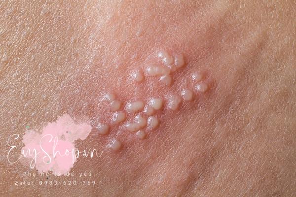 Nhận biết các triệu chứng bệnh herpes sinh dục