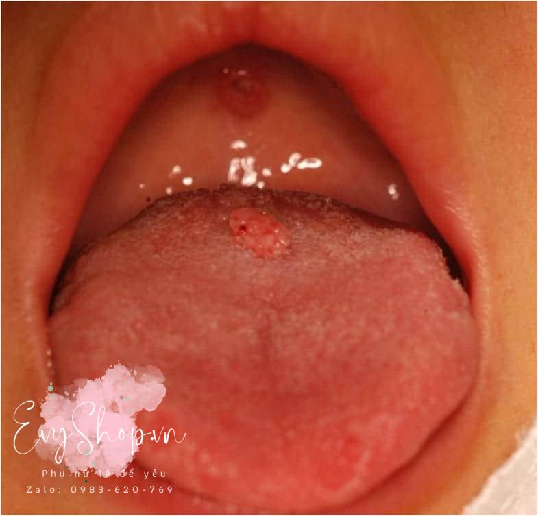 Mức độ nguy hiểm của bệnh sùi mào gà ở miệng và cách phân biệt với nhiệt miệng