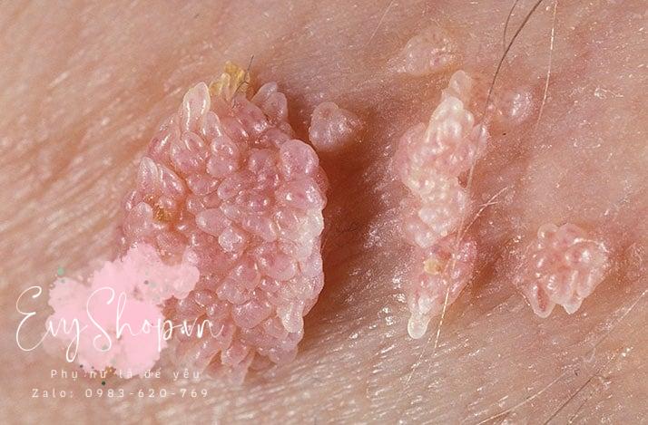 Bạn nên làm gì khi phát hiện dấu hiệu sùi mào gà ở nữ?